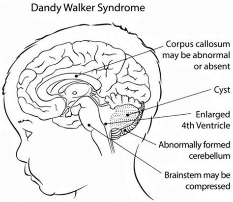 Dandy Walker syndrome causes, symptoms, diagnosis, treatment & prognosis