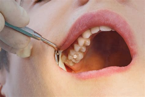 Cracked Tooth Management - Heatherton Dental