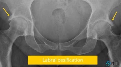 Hip MRI ? Show me the Xray: Acetabular Rim Ossifications. How to make ...