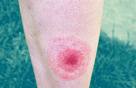 What Does a Lyme Disease Rash Really Look Like? These Pictures Explain It — Health | Lyme ...