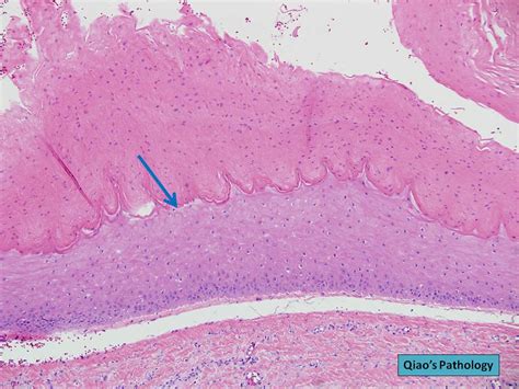 Qiao's Pathology: Pilar Cyst (Sebaceous Cyst) {乔氏病理学：毛发囊肿（… | Flickr