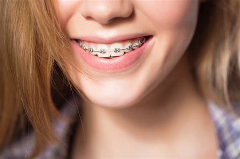 Braces Pain? Here’s How to Soothe Your Mouth at Home | Dentist & Orthodontist in Covina, CA