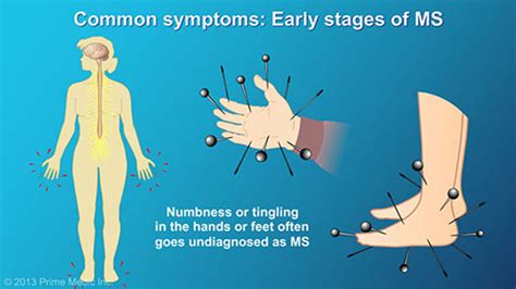 Understanding Multiple Sclerosis