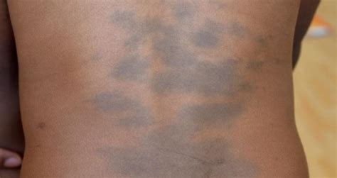 Mongolian Birthmark or Spot: Causes, Signs & Removal - Skincarederm