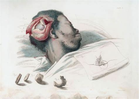 An illustrated history of trepanation | Medical art, Medical illustration, Illustration