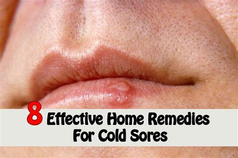 8 Effective Home Remedies for Kicking Cold Sores - Home and Gardening Ideas