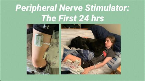 Peripheral Nerve Stimulater: Surgery & Device Recap - YouTube