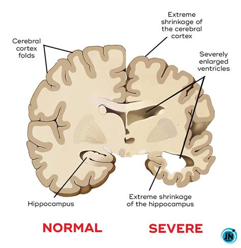 Alzheimer's Disease No cure exists! - JustNaija