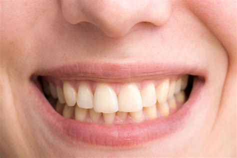 ¿Dientes torcidos? Sonrisa para Todos Dentistas Costa Rica