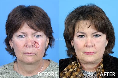 Cheek Reconstruction | Facial Plastic Surgery Center | Washington ...