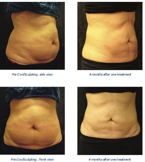 CoolSculpting Twin Cities & Minneapolis | Dermatology Consultants