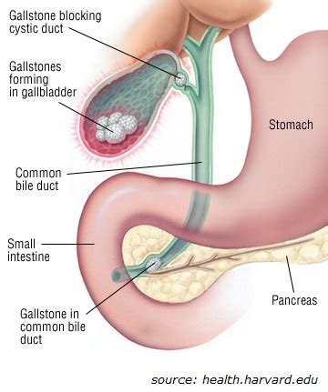 Laparoscopic Cholecystectomy Anatomy