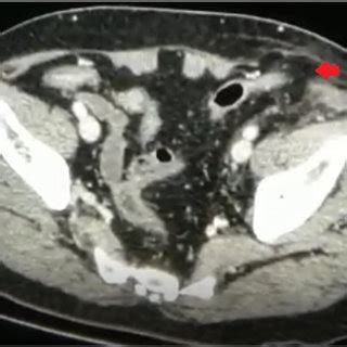 CT axial view showing left iliac fossa traumatic hernia. | Download Scientific Diagram