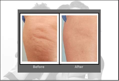 Cellulite Treatment | Cellulaze™ Laser Procedure | Hartford CT