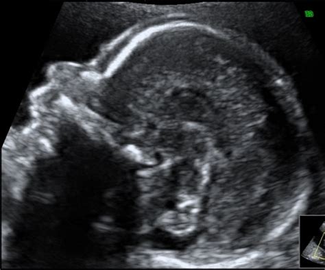 20 Weeks ultrasound – Maternal Fetal Medicine