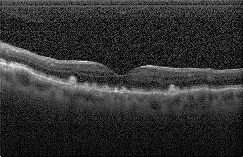 Deep Learning Classification of Drusen, Choroidal Neovascularization, and Diabetic Macular Edema ...