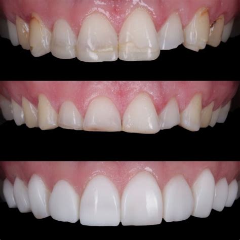 Composite Bonding - Cambridge Dental