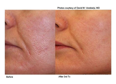 Laser Genesis Skin Rejuvenation | Face R-X Medspa