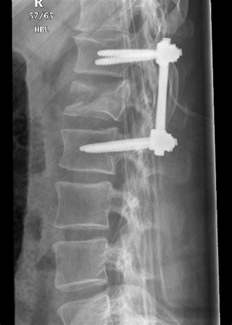 lumbar region muscles