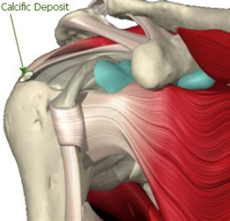 Calcific Tendonitis | Brisbane Knee and Shoulder Clinic | Dr ...