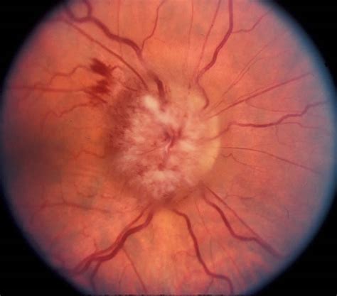 Papilledema causes, symptoms, grades, stages & papilledema treatment