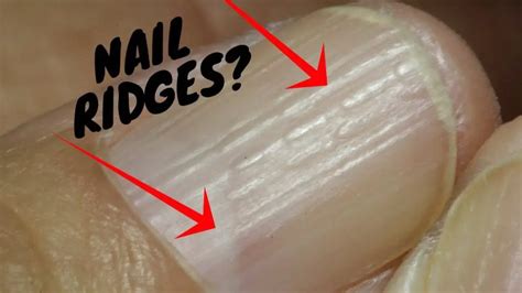 Do You Have These Vertical Ridges On Your Nails?