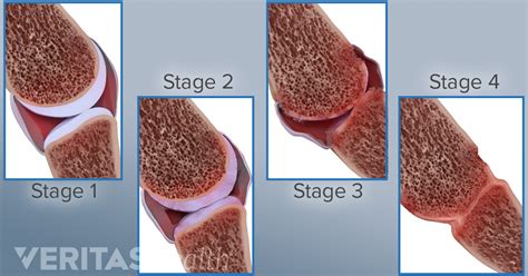 Rheumatoid Arthritis (RA) Diagnosis