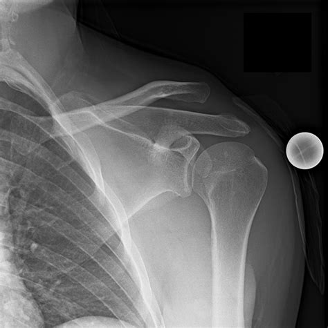 Shoulder Dislocation | Shoulder Separation | Vail, Aspen, Denver CO