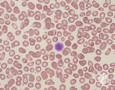 Giant platelets