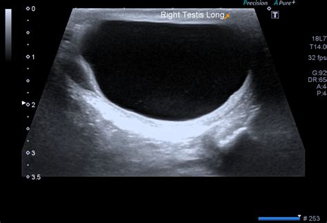 Intratesticular spermatocele | Image | Radiopaedia.org