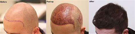 5,000 FUE Graft Hair Transplant - One Session - Alvi Armani - Hair ...