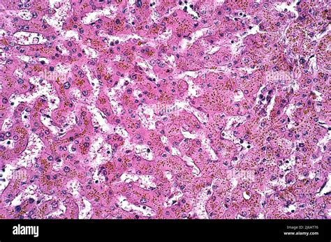 Hepatic hemosiderosis, light micrograph Stock Photo - Alamy