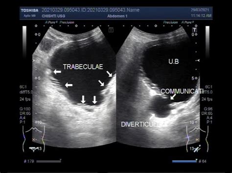 Bladder Diverticulum Ultrasound