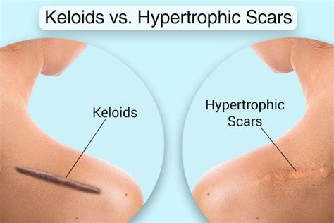 The Difference between Keloid & Hypertrophic scars