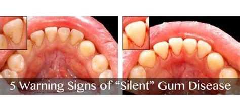 5 Warning Signs of “Silent” Gum Disease | Soft Touch Dentistry