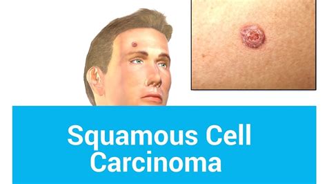 Squamous Cell Cancer Symptoms