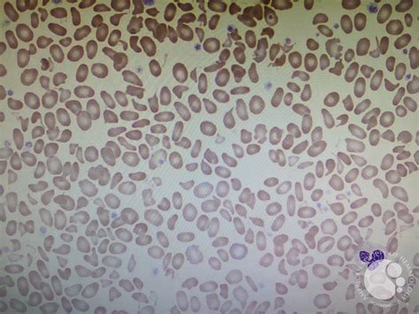 Hereditary Pyropoikilocytosis (SPTA1 Gene Pathologic Variant)