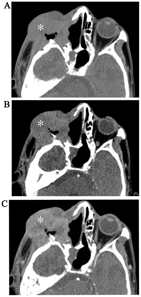 Computed tomography and magnetic resonance imaging findings of malignant fibrous histiocytoma of ...