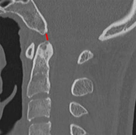 Atlanto Occipital Joint Xray