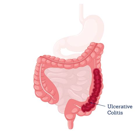 Ulcerative Colitis Treatment - Dr. Diego Marines