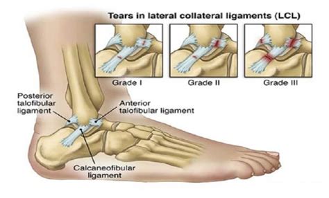 Ankle Sprain – Dr Anjan A