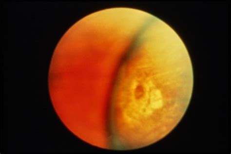 Lattice Degeneration With Atrophic Hole - Retina Image Bank