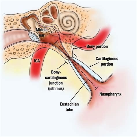 Eustachian Tube Balloon Dilation - Ear & Sinus Institute