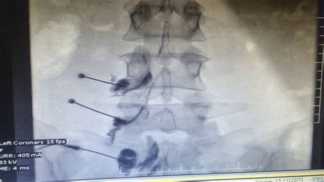 Technique to do Transforaminal Epidural steroid injection (TFESI) under fluoroscopic guidance ...