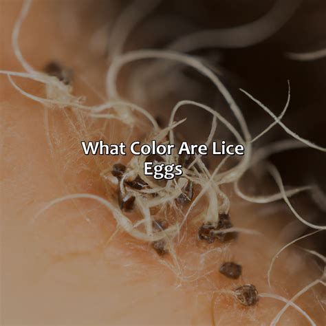 What Color Are Lice Eggs - colorscombo.com