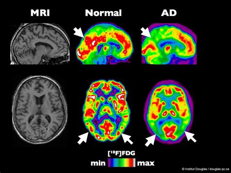 PET scan of an healthy brain compared to a brain at an ear… | Flickr