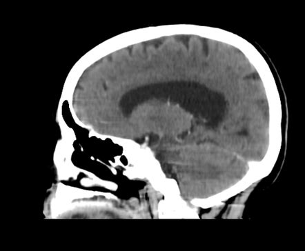 Optic nerve sheath meningioma - axial exophthlmos grade 3 | Image | Radiopaedia.org