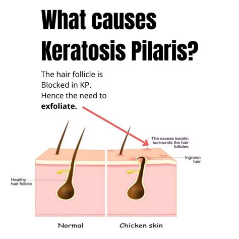 Best Keratosis Pilaris Treatment In Australia | Dr Davin Lim