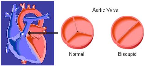 Bicuspid Aortic Valve: Symptoms, Diagnosis & Treatments | SingHealth