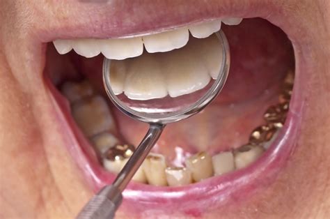 An Introduction to Gold Dental Crowns & Their Uses Throughout History - Randall A. Ellis DDS ...